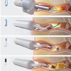 گوش پاک کن هوشمند شیائومی مدل Bebird R37R